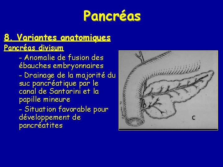 Pancréas 8. Variantes anatomiques Pancréas divisum - Anomalie de fusion des ébauches embryonnaires -