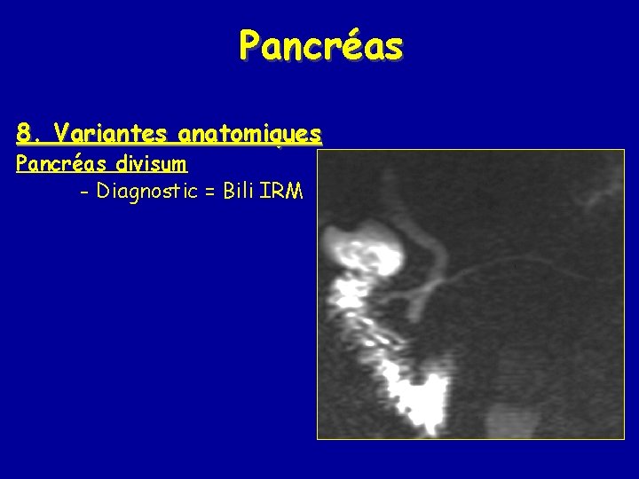 Pancréas 8. Variantes anatomiques Pancréas divisum - Diagnostic = Bili IRM 