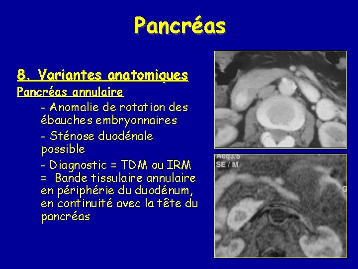 Pancréas 8. Variantes anatomiques Pancréas annulaire - Anomalie de rotation des ébauches embryonnaires -