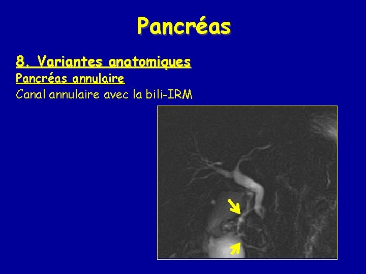 Pancréas 8. Variantes anatomiques Pancréas annulaire Canal annulaire avec la bili-IRM 