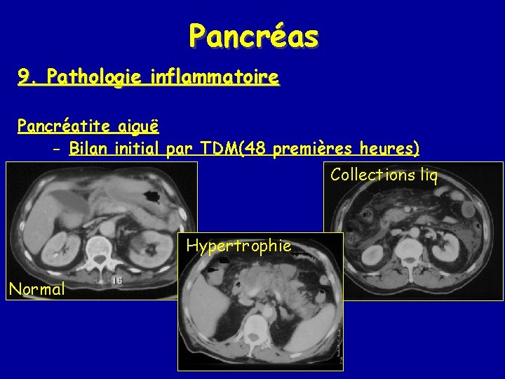 Pancréas 9. Pathologie inflammatoire Pancréatite aiguë - Bilan initial par TDM(48 premières heures) Collections