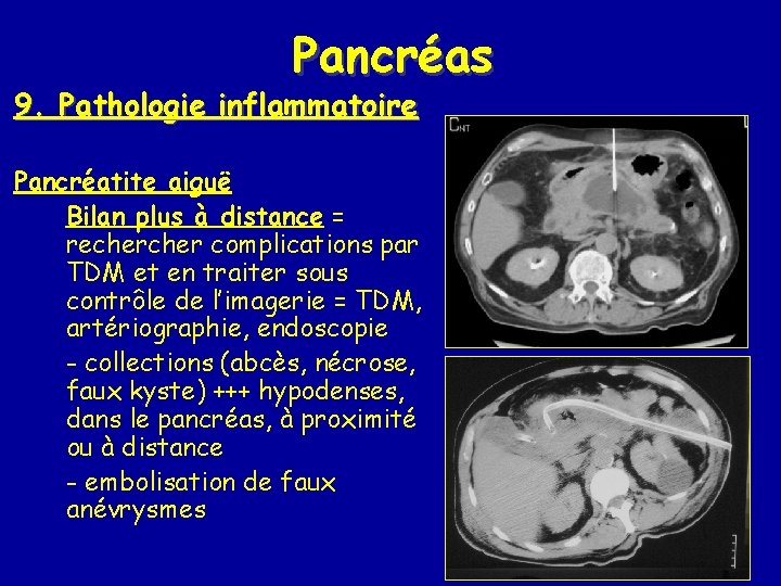 Pancréas 9. Pathologie inflammatoire Pancréatite aiguë Bilan plus à distance = recher complications par
