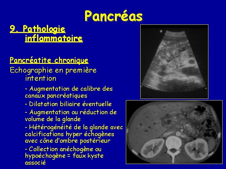 9. Pathologie inflammatoire Pancréas Pancréatite chronique Echographie en première intention - Augmentation de calibre