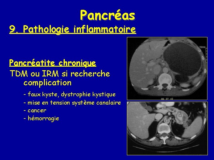 Pancréas 9. Pathologie inflammatoire Pancréatite chronique TDM ou IRM si recherche complication - faux