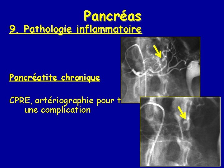 Pancréas 9. Pathologie inflammatoire Pancréatite chronique CPRE, artériographie pour traiter une complication 