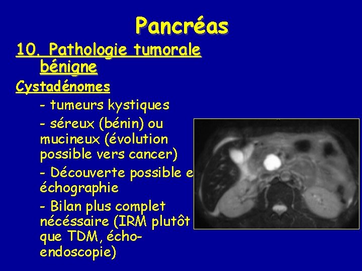 Pancréas 10. Pathologie tumorale bénigne Cystadénomes - tumeurs kystiques - séreux (bénin) ou mucineux