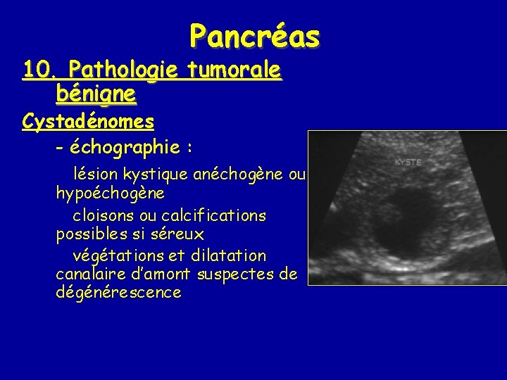 Pancréas 10. Pathologie tumorale bénigne Cystadénomes - échographie : lésion kystique anéchogène ou hypoéchogène