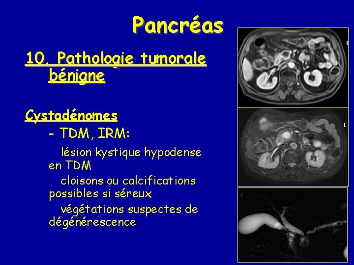 Pancréas 10. Pathologie tumorale bénigne Cystadénomes - TDM, IRM: lésion kystique hypodense en TDM