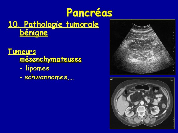 Pancréas 10. Pathologie tumorale bénigne Tumeurs mésenchymateuses - lipomes - schwannomes, … 