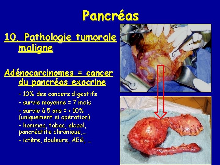 Pancréas 10. Pathologie tumorale maligne Adénocarcinomes = cancer du pancréas exocrine - 10% des Pancréas 10. Pathologie tumorale maligne Adénocarcinomes = cancer du pancréas exocrine - 10% des