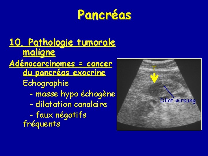 Pancréas 10. Pathologie tumorale maligne Adénocarcinomes = cancer du pancréas exocrine Echographie - masse