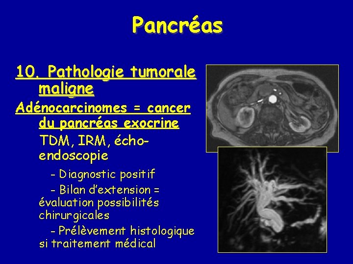 Pancréas 10. Pathologie tumorale maligne Adénocarcinomes = cancer du pancréas exocrine TDM, IRM, échoendoscopie
