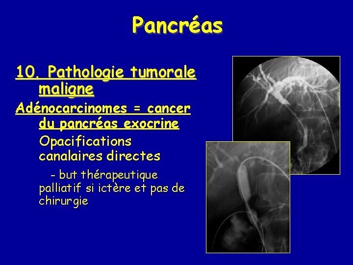 Pancréas 10. Pathologie tumorale maligne Adénocarcinomes = cancer du pancréas exocrine Opacifications canalaires directes