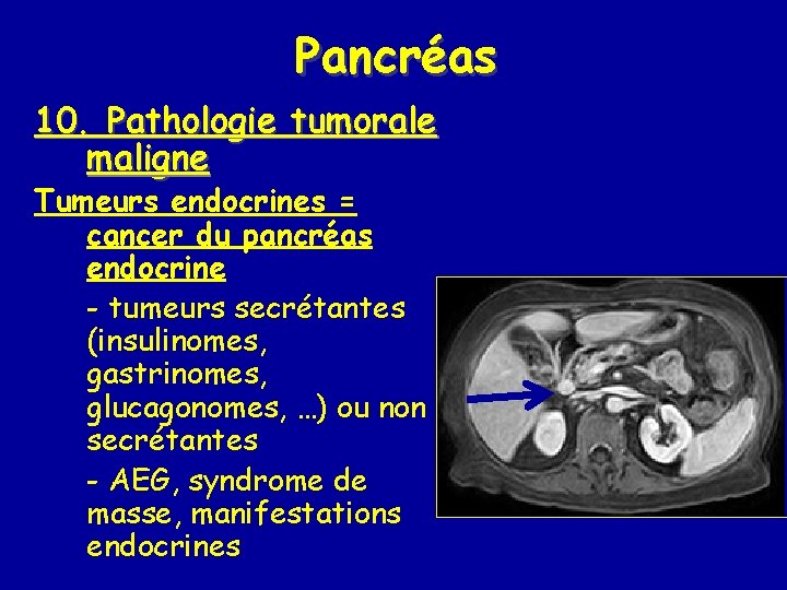 Pancréas 10. Pathologie tumorale maligne Tumeurs endocrines = cancer du pancréas endocrine - tumeurs