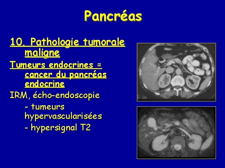 Pancréas 10. Pathologie tumorale maligne Tumeurs endocrines = cancer du pancréas endocrine IRM, écho-endoscopie