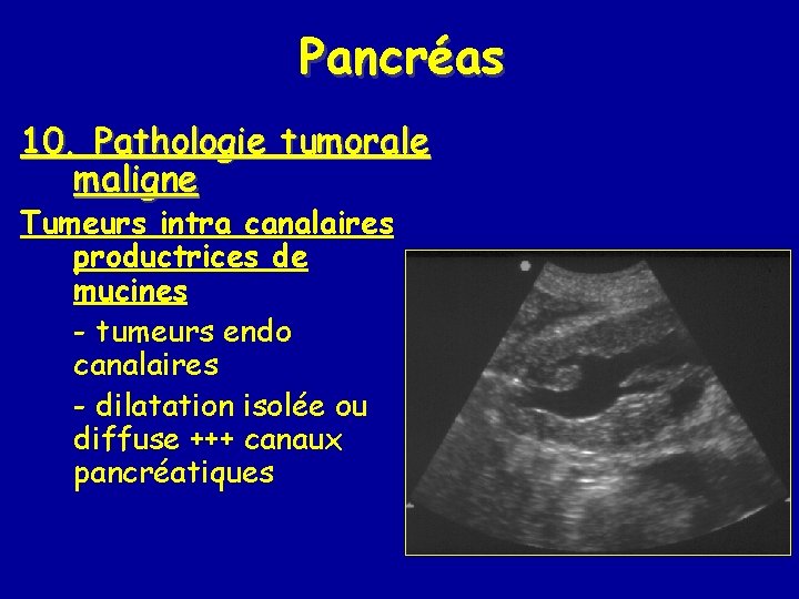 Pancréas 10. Pathologie tumorale maligne Tumeurs intra canalaires productrices de mucines - tumeurs endo