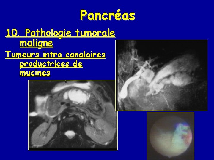 Pancréas 10. Pathologie tumorale maligne Tumeurs intra canalaires productrices de mucines 