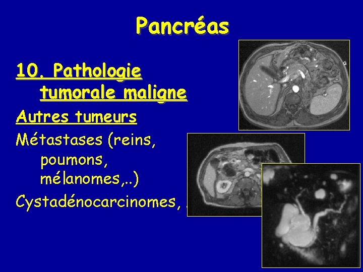 Pancréas 10. Pathologie tumorale maligne Autres tumeurs Métastases (reins, poumons, mélanomes, . . )