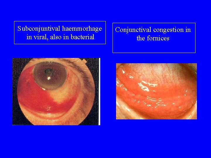 Subconjuntival haemmorhage in viral, also in bacterial Conjunctival congestion in the fornices 