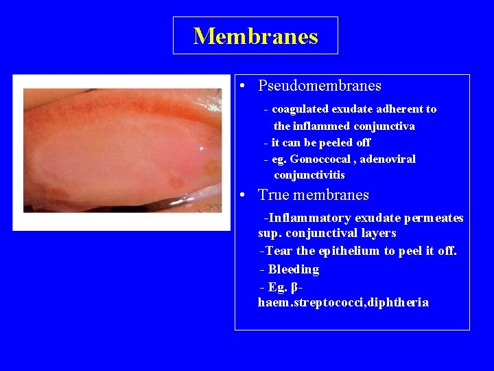 Membranes • Pseudomembranes - coagulated exudate adherent to the inflammed conjunctiva - it can