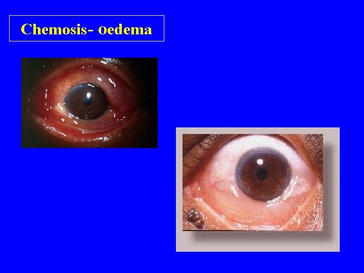 Chemosis- oedema 