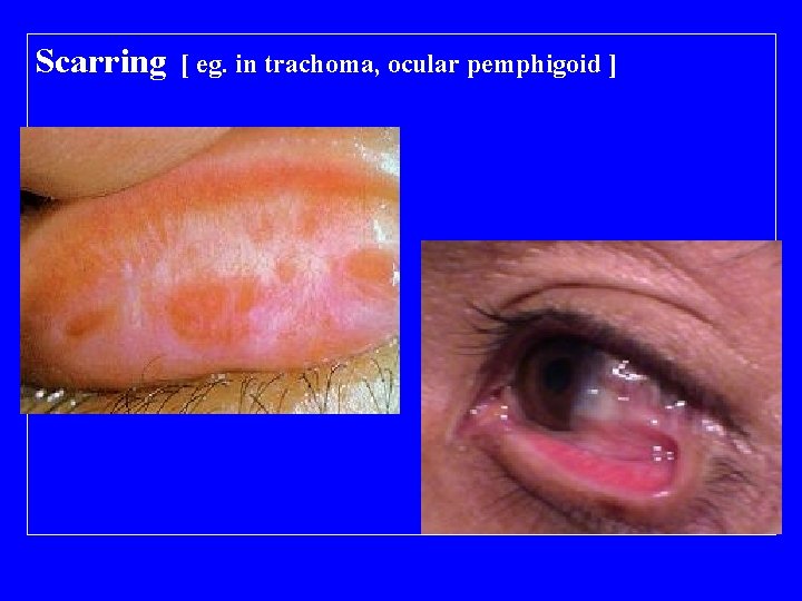 Scarring [ eg. in trachoma, ocular pemphigoid ] 