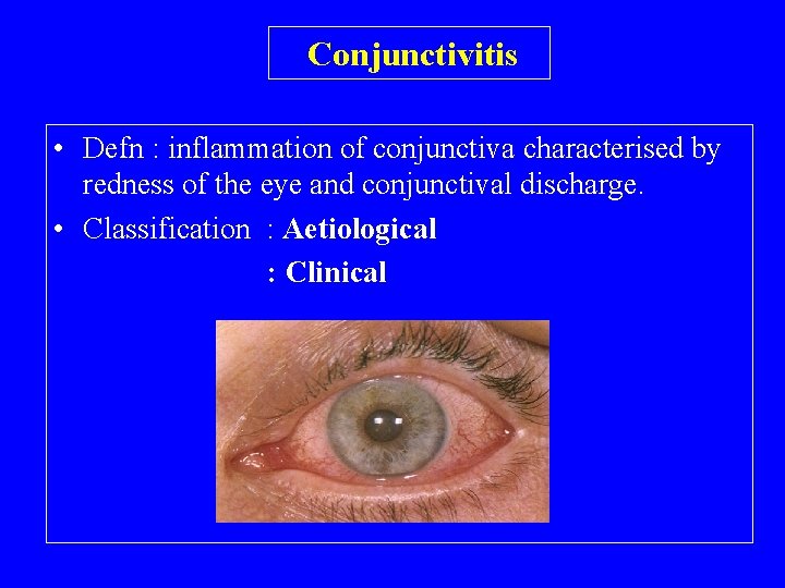 Conjunctivitis • Defn : inflammation of conjunctiva characterised by redness of the eye and