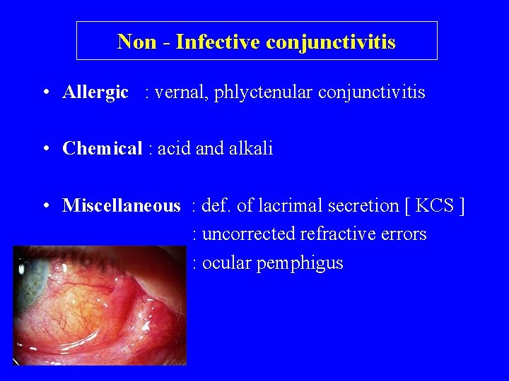 Non - Infective conjunctivitis • Allergic : vernal, phlyctenular conjunctivitis • Chemical : acid