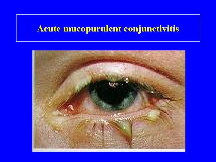 Acute mucopurulent conjunctivitis 