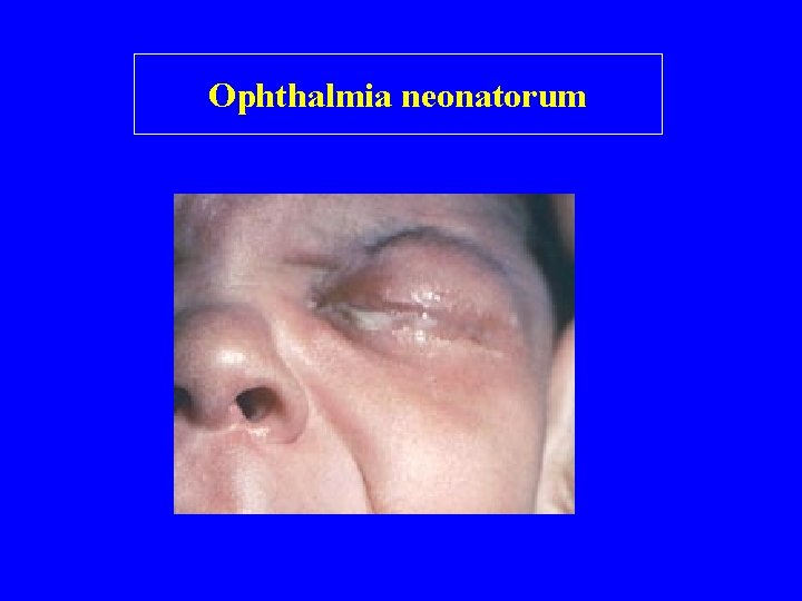 Ophthalmia neonatorum 