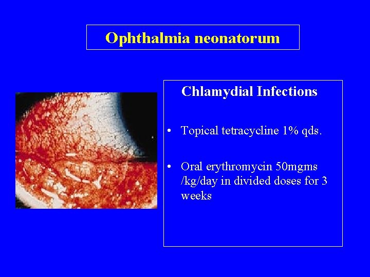 Ophthalmia neonatorum Chlamydial Infections • Topical tetracycline 1% qds. • Oral erythromycin 50 mgms
