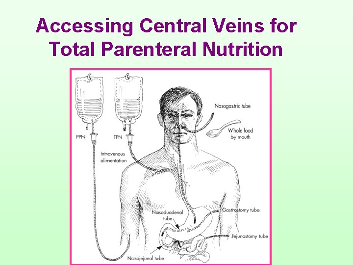 Accessing Central Veins for Total Parenteral Nutrition 