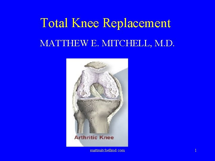 Total Knee Replacement MATTHEW E. MITCHELL, M. D. mattmitchellmd. com 1 