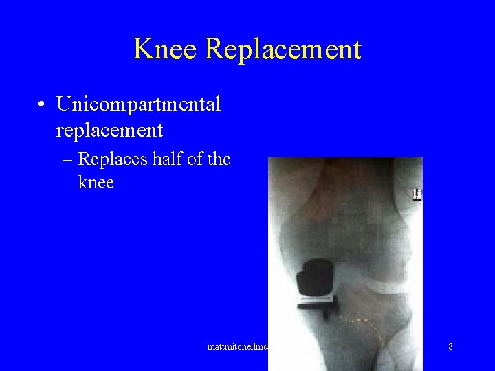 Knee Replacement • Unicompartmental replacement – Replaces half of the knee mattmitchellmd. com 8