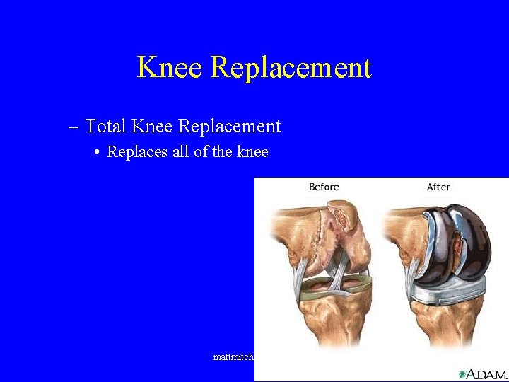 Knee Replacement – Total Knee Replacement • Replaces all of the knee mattmitchellmd. com