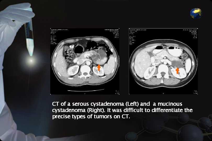 CT of a serous cystadenoma (Left) and a mucinous cystadenoma (Right). It was difficult