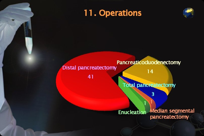 11. Operations Distal pancreatectomy 41 Pancreaticoduodenectomy 14 Total pancreatectomy 3 1 1 Enucleation Median