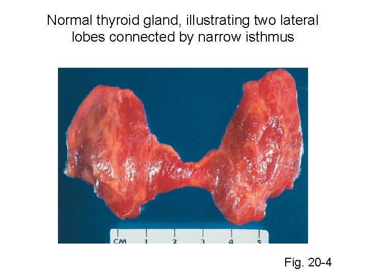 Normal thyroid gland, illustrating two lateral lobes connected by narrow isthmus Fig. 20 -4