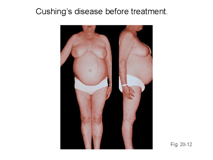 Cushing’s disease before treatment. Fig. 20 -12 