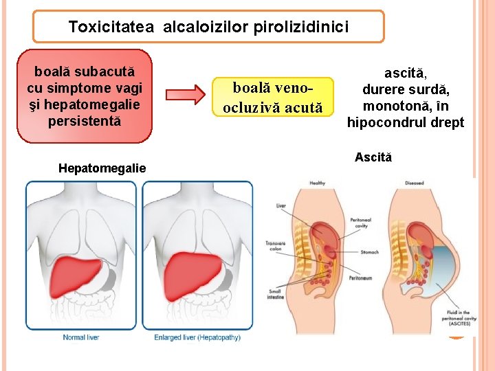 Toxicitatea alcaloizilor pirolizidinici boală subacută cu simptome vagi şi hepatomegalie persistentă Hepatomegalie boală venoocluzivă