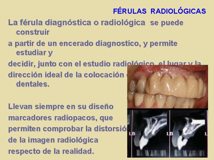 FÉRULAS RADIOLÓGICAS La férula diagnóstica o radiológica se puede construir a partir de un