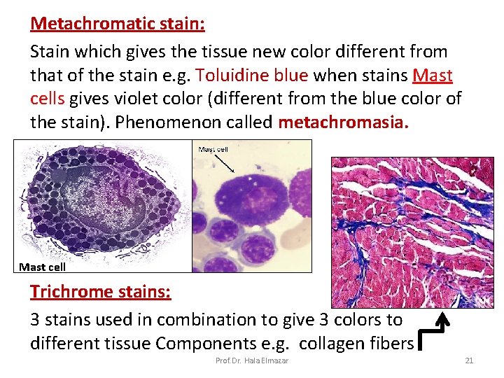 Metachromatic stain: Stain which gives the tissue new color different from that of the