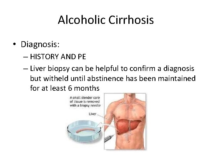 Alcoholic Cirrhosis • Diagnosis: – HISTORY AND PE – Liver biopsy can be helpful