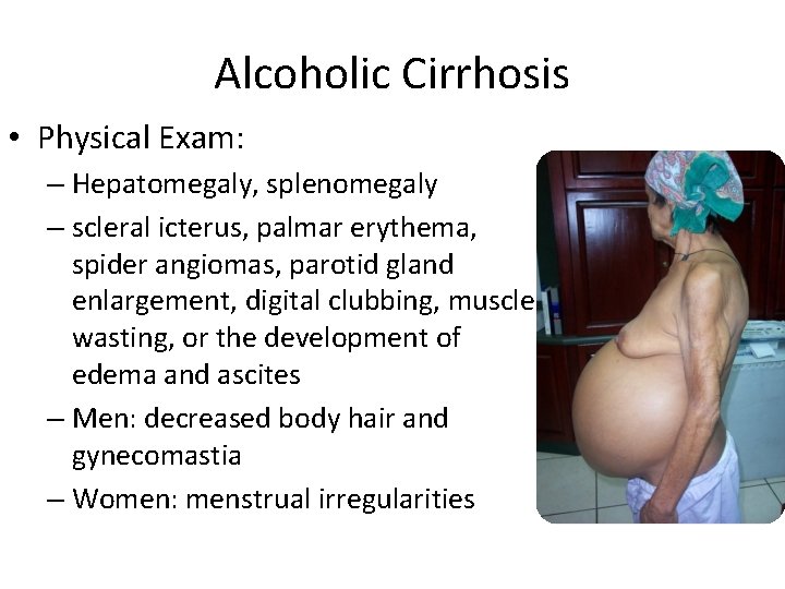 Alcoholic Cirrhosis • Physical Exam: – Hepatomegaly, splenomegaly – scleral icterus, palmar erythema, spider