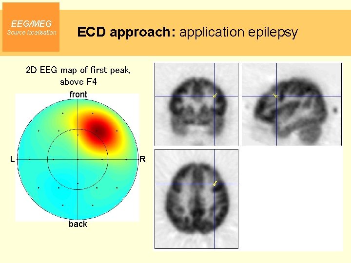 EEG/MEG Source localisation ECD approach: application epilepsy 2 D EEG map of first peak,