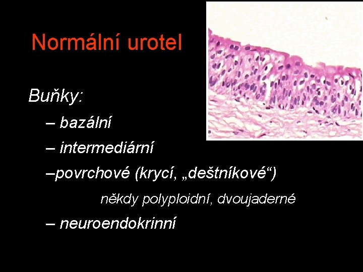 Normální urotel Buňky: – bazální – intermediární –povrchové (krycí, „deštníkové“) někdy polyploidní, dvoujaderné –