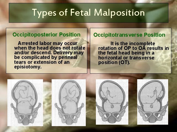 Types of Fetal Malposition Occipitoposterior Position Arrested labor may occur when the head does Types of Fetal Malposition Occipitoposterior Position Arrested labor may occur when the head does