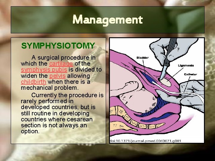 Management SYMPHYSIOTOMY A surgical procedure in which the cartilage of the symphysis pubis is Management SYMPHYSIOTOMY A surgical procedure in which the cartilage of the symphysis pubis is