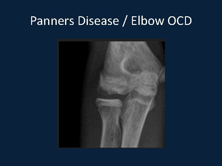 Panners Disease / Elbow OCD 