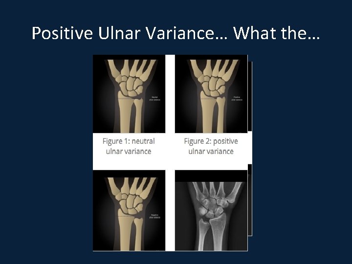 Positive Ulnar Variance… What the… 